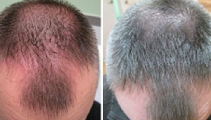 Могут ли выпадать волосы после мезотерапии